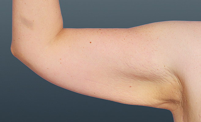 CoolSculpting-руки после процедуры