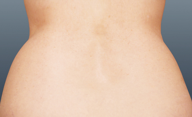 CoolSculpting-скульптор женского тела до процедуры